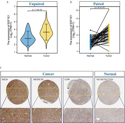 A Novel HCC Prognosis Predictor EEF1E1 Is Related to Immune Infiltration and May Be Involved in EEF1E1/ATM/p53 Signaling